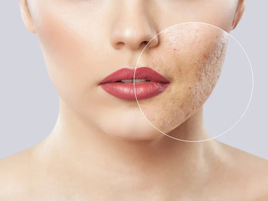 Micro Silver skincare range – Say Goodbye to Blemishes with Microsilver